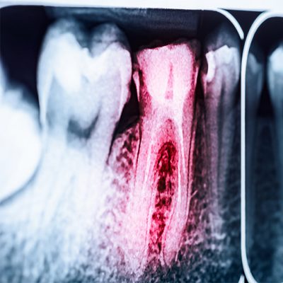 endodonzia